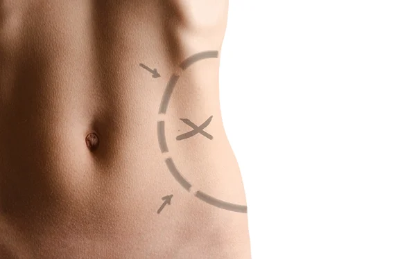 Female waistline about to perform liposuction — Stock Photo, Image