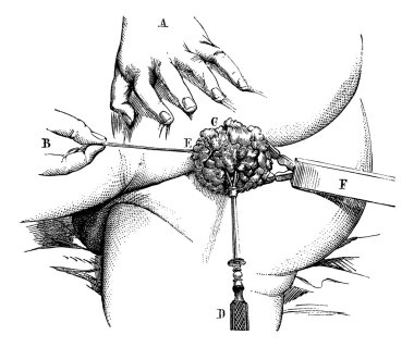 Removal of a hemorrhoidal pad with a linear crusher, vintage eng clipart