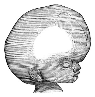 Hydrocephalus, vintage engraving. clipart