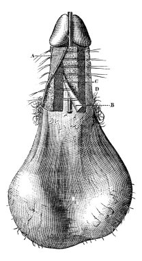 Operasyon hypospadias (th öfke için işlem), vintage engravi