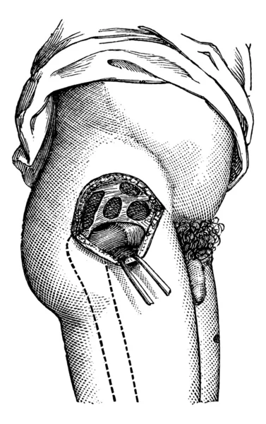Articulación de la cadera abierta por el exterior, para mostrar el cuello del fémur , — Vector de stock