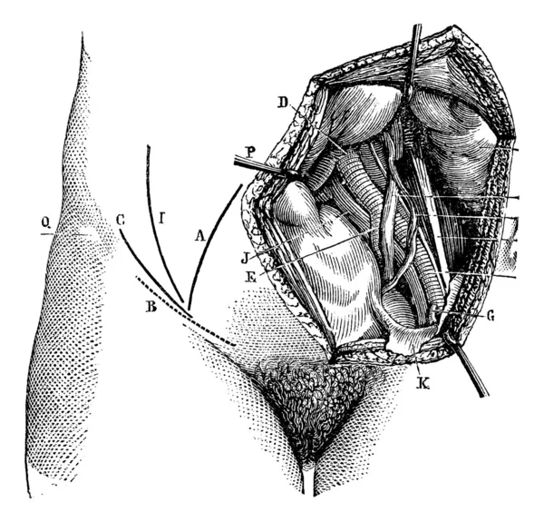 Фиг. 618. Илиачная артерия и ее ветви, винтажная гравировка . — стоковый вектор