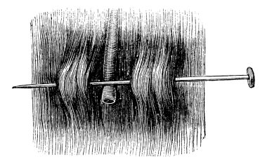 Acupressure with a single needle, vintage engraving. clipart