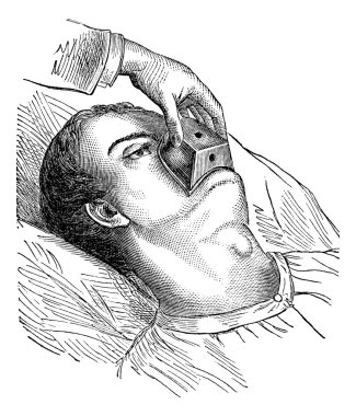 Application of a cone chloroform, vintage engraving. clipart