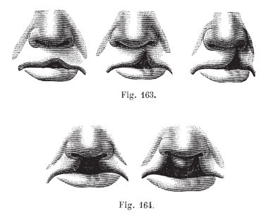 Fig. 163. Degrees of cleft lip simple, Fig. 164. Cleft lip doub clipart