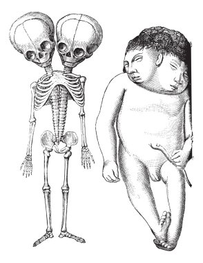 Fig. 174. Skeleton of two-headed monster derodyme. (Musee Dupuyt clipart