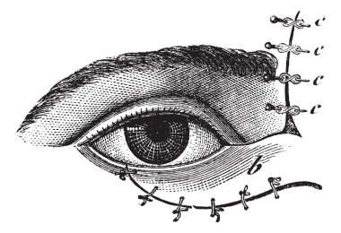 Fig. 178. Blepharoplasty by the method of Blasius, vintage engra clipart