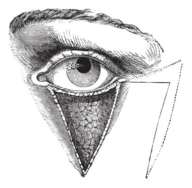 Fig. 179. Blepharoplasty by the method of Dieffembach, vintage e clipart