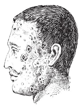 Human face infected with impetigo vintage engraving clipart