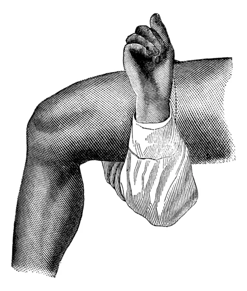 Amputace stehna metodou kruhový (kožní řez), — Stockový vektor