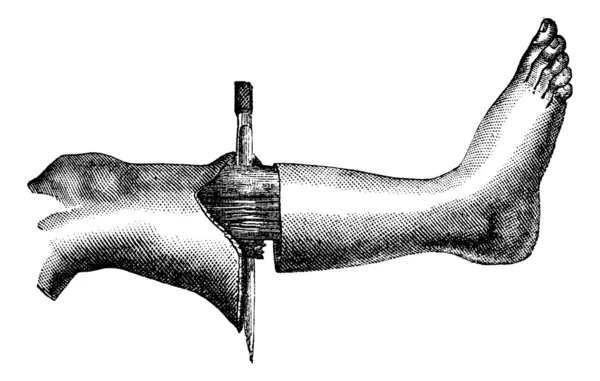 La amputación de la pierna por el método tiene dos solapas (inci circular — Archivo Imágenes Vectoriales