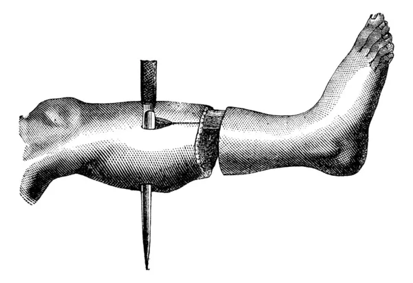 Amputazione della gamba con il metodo ha due lembi (formazione di — Vettoriale Stock