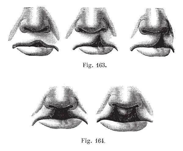 Fig. 163. Gradi di labbro leporino semplice, Fico. 164. Cleft labbro doub — Vettoriale Stock