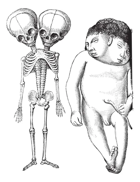 Рис. 174. Скелет двоголового монстра derodyme. (Музей Dupuyt — стоковий вектор