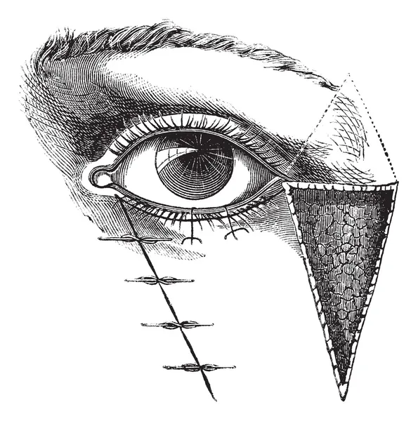 図 180。ヴィンテージ e dieffembach 法による眼瞼形成術 — ストックベクタ