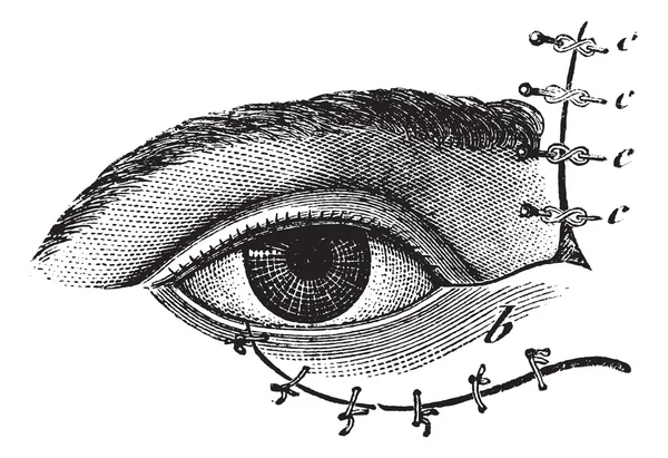 Fig. 178. Blefaroplastica con il metodo di Blasius, engra vintage — Vettoriale Stock
