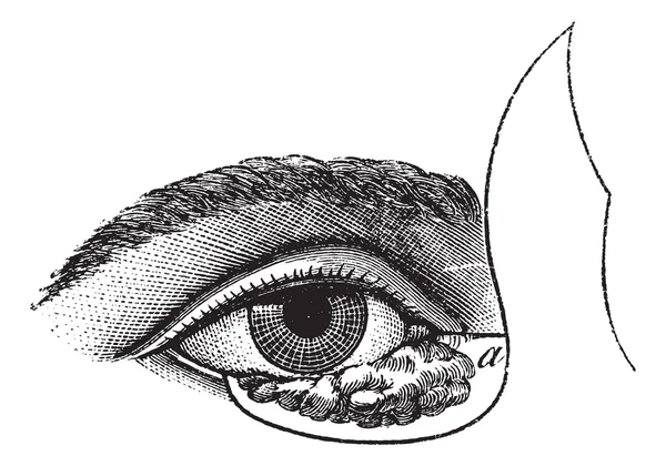 図 177。ビンテージ engra コリオリ力場法による眼瞼形成術 — ストックベクタ