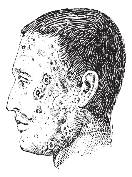 Impetigo vintage oyma ile enfekte insan yüzü — Stok Vektör