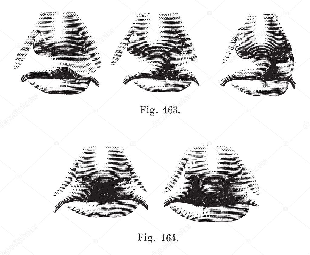 Fig. 163. Degrees of cleft lip simple, Fig. 164. Cleft lip doub