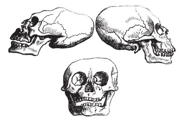 Positional plagiocephaly or Deformational plagiocephaly, vintage clipart