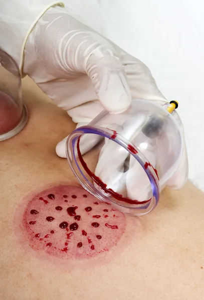Coppa medico coppa aperta mostra flussi di sangue sporco — Foto Stock