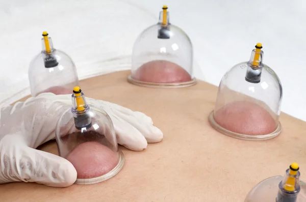 Multiple cup of medical cupping therapy — Stock Photo, Image