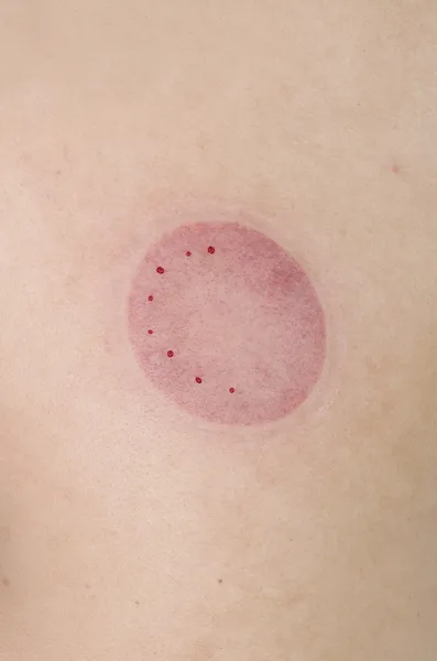 Skin mark with some blood after pinned — Stock Photo, Image