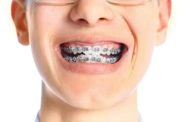 Close-up de dente com aparelho . — Fotografia de Stock