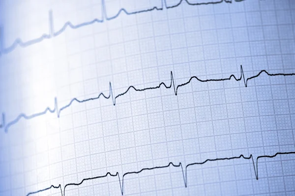 Electrocardiograma —  Fotos de Stock
