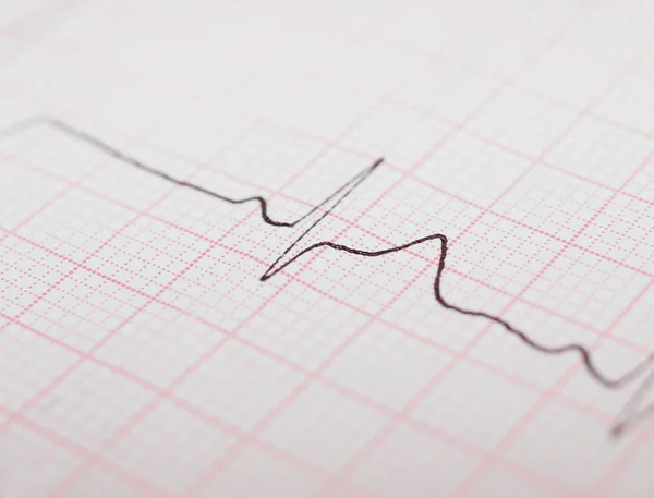 EKG-grafikon, EKG ekg — Stock Fotó