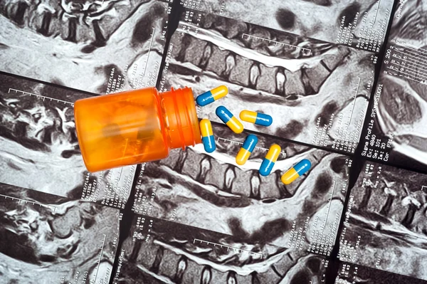 Tabletki na mri kręgosłupa — Zdjęcie stockowe