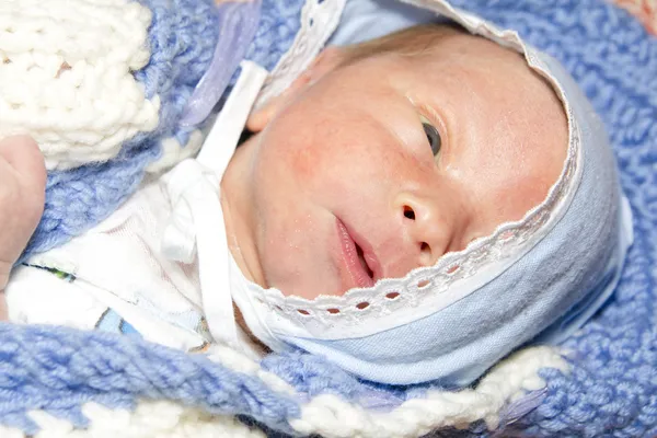 stock image Newborn infant with allergic diathesis