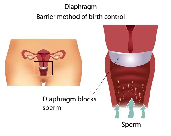 Метод контрацепции - диафрагма — стоковый вектор