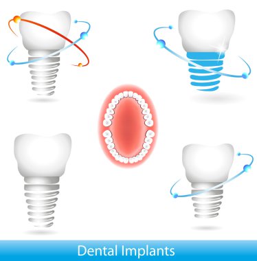 Dental implants clipart