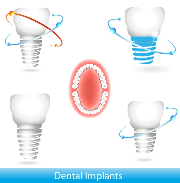 Zubní implantáty — Stockový vektor