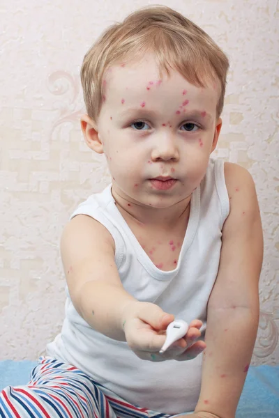 Rapaz sofre de varicela — Fotografia de Stock