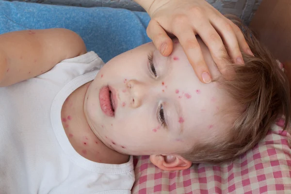 Close up boy with chickenpox — Stock Photo, Image