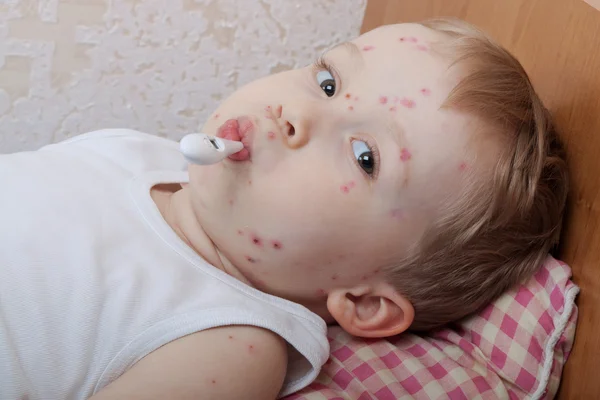 Portrait of little boy with chickenpox — Stock Photo, Image