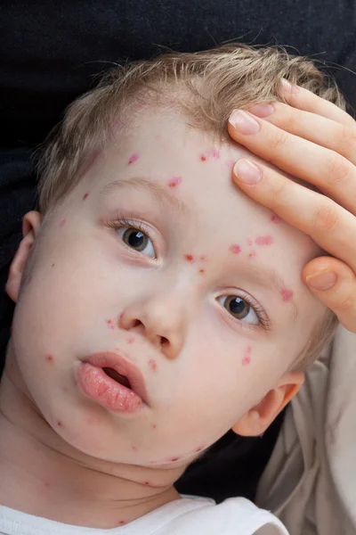 Fechar menino com varicela — Fotografia de Stock