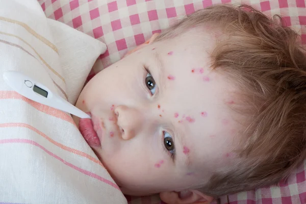 Retrato de niño pequeño con varicela — Foto de Stock