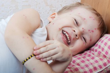 Chickenpox clipart