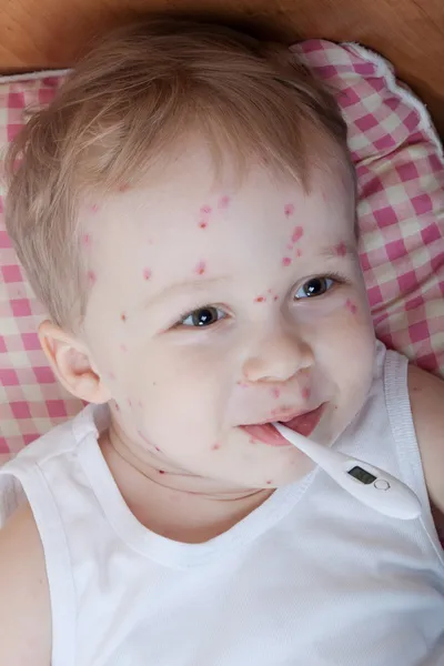 Portrait of little boy with chickenpox — Stock Photo, Image