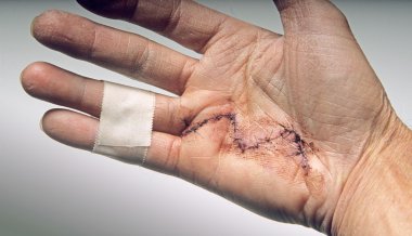 Hand surgery clipart