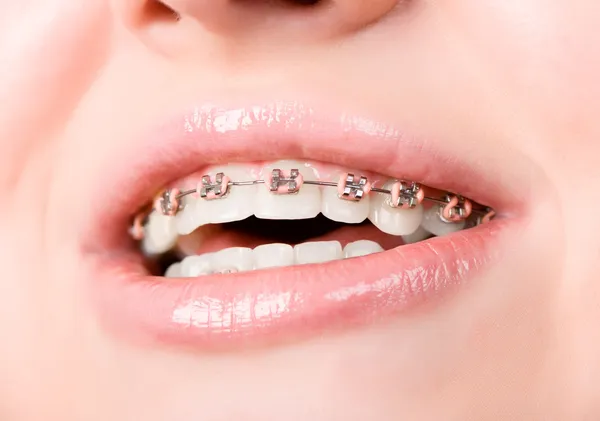 Красивая молодая женщина со скобками на зубах Стоковое Изображение