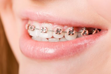 Young woman with brackets on teeth clipart