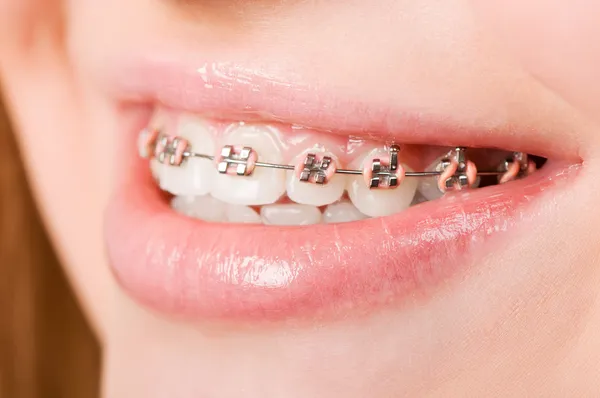 Jeune femme avec des crochets sur les dents — Photo