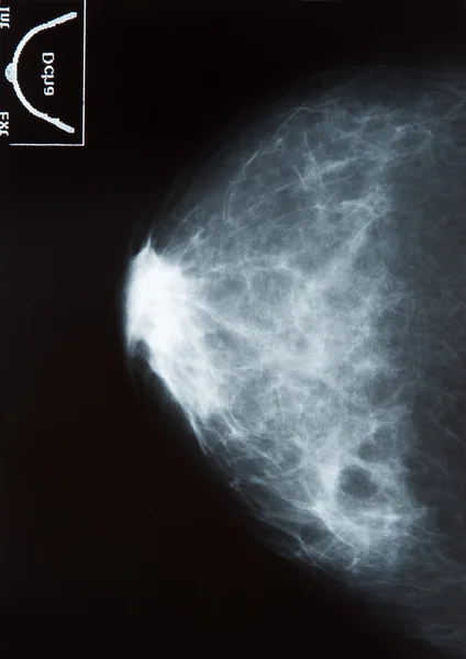 乳房X光摄影 — 图库照片