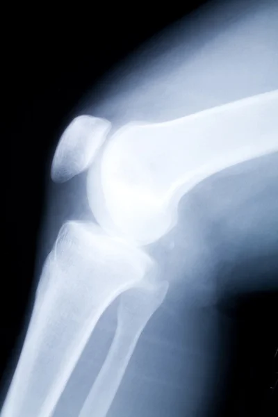 Zdjęcie rentgenowskie kolana — Zdjęcie stockowe