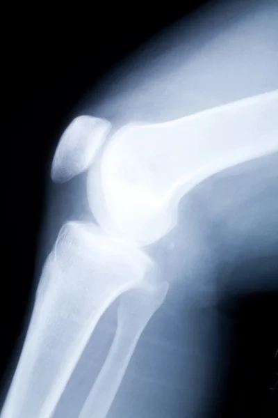 Knie x-ray afbeelding — Stockfoto