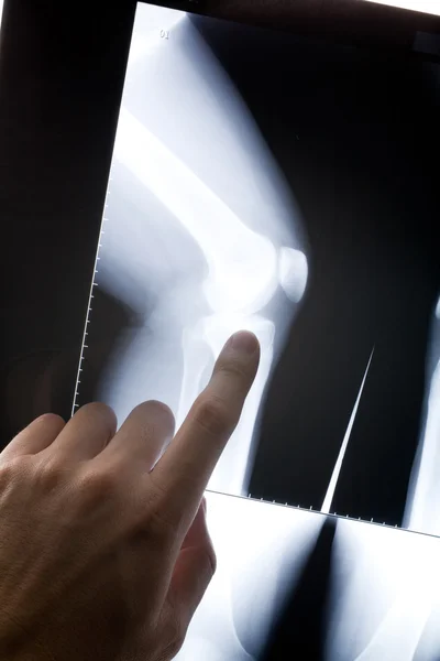 Knee x-ray image — Stock Photo, Image